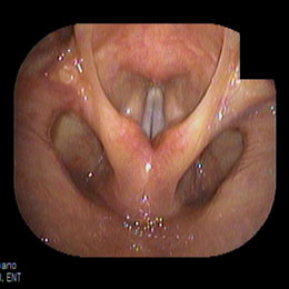 正常な声帯　発声時