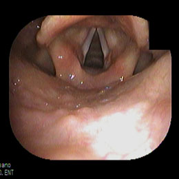 正常な声帯　吸気時