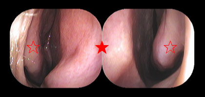 右鼻腔と左鼻腔