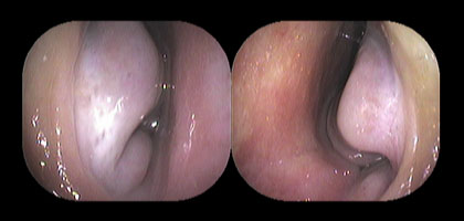 右鼻腔と左鼻腔