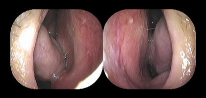 右鼻腔と左鼻腔