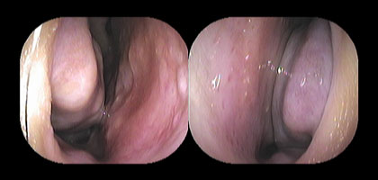 右鼻腔と左鼻腔