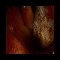 STEP03.治療の直後