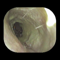 左外耳炎（重症）初診日